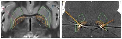 Deep Brain Stimulation in KMT2B-Related Dystonia: Case Report and Review of the Literature With Special Emphasis on Dysarthria and Speech